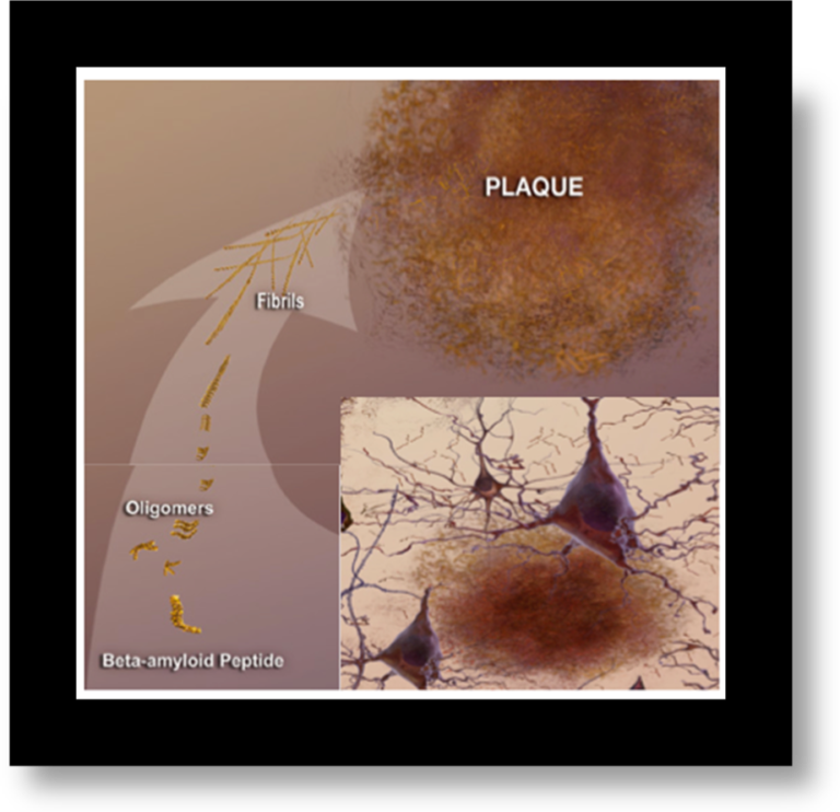 amyloid-plaques